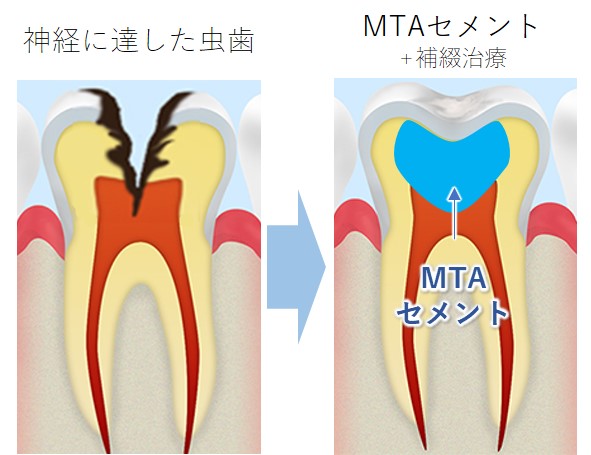 日野市（平山城址公園）の歯医者、SERAデンタルオフィス 平山城址公園駅前歯科のMTAセメント