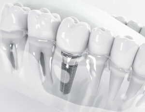 日野市（平山城址公園）の歯医者、SERAデンタルオフィス 平山城址公園駅前歯科でインプラント治療から数年後に痛みが出る理由について解説