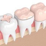 日野市（平山城址公園）の歯医者、SERAデンタルオフィス 平山城址公園駅前歯科で、仮歯で痛みが出る原因について解説