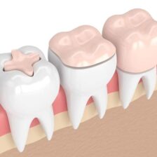 日野市（平山城址公園）の歯医者、SERAデンタルオフィス 平山城址公園駅前歯科で、仮歯で痛みが出る原因について解説