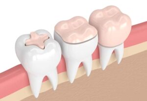 日野市（平山城址公園）の歯医者、SERAデンタルオフィス 平山城址公園駅前歯科で、仮歯で痛みが出る原因について解説